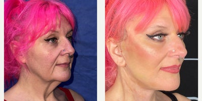 Deep Plane Facelift before and after photo