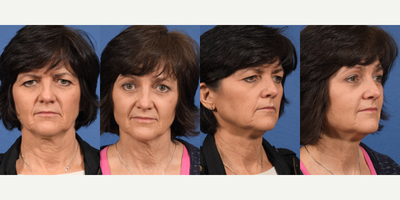 Eyelid Surgery before and after photo