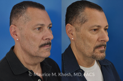 Facelift before and after photo