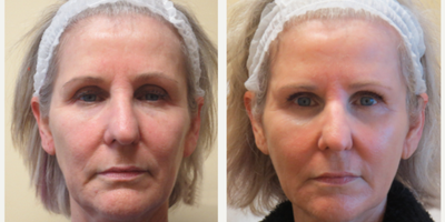 before and after image