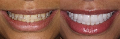 Smile Makeover before and after photo