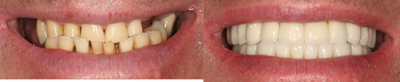 Dental Implants before and after photo