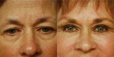 Eyelid Surgery before and after photo