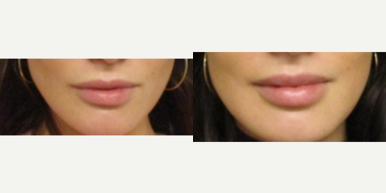 Juvederm before and after photo