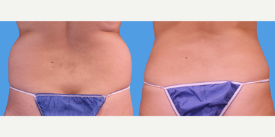Liposuction before and after photo