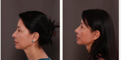 MACS Facelift before and after photo