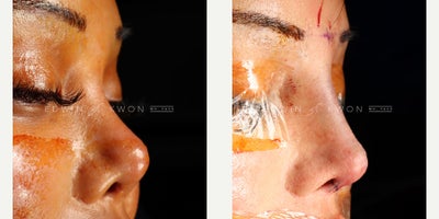 Revision Rhinoplasty before and after photo
