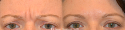 Botox before and after photo