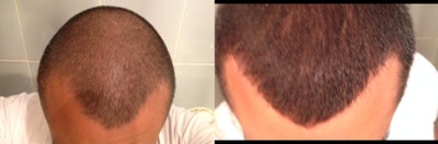 FUE Hair Transplant before and after photo