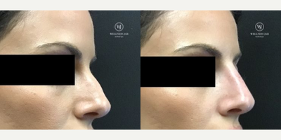 Juvederm before and after photo