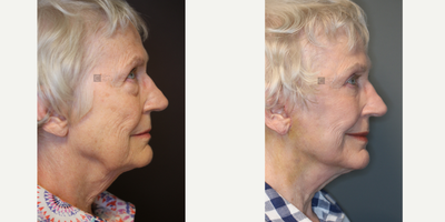 before and after image