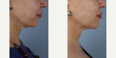 AccuTite before and after photo