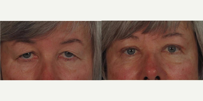Eyelid Surgery before and after photo