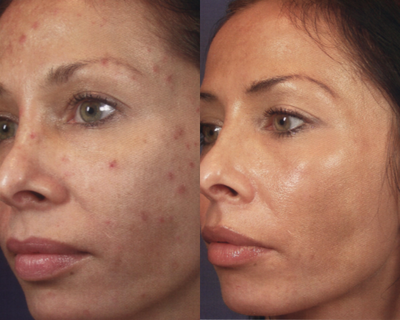 Chemical Peel before and after photo