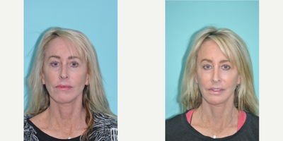 CO2 Laser before and after photo