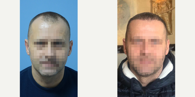FUE Hair Transplant before and after photo