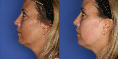 IPL before and after photo
