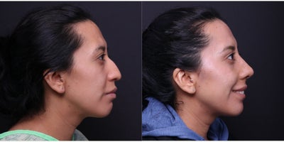 Rhinoplasty before and after photo