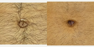 Belly Button Surgery before and after photo
