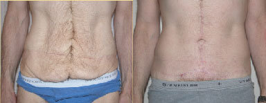 Body Lift before and after photo