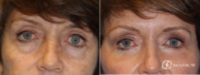 Eyelid Surgery before and after photo