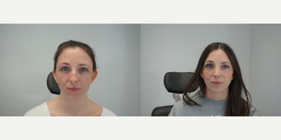 Rhinoplasty before and after photo