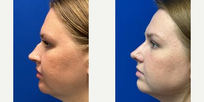 Rhinoplasty before and after photo