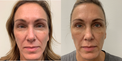 Facial Fat Transfer before and after photo