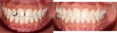 Invisalign before and after photo