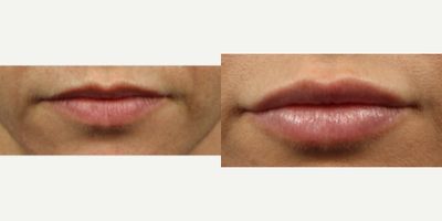 Juvederm before and after photo