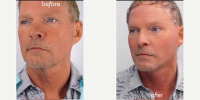 Nonsurgical Facelift before and after photo
