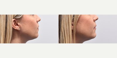 Chin Filler before and after photo