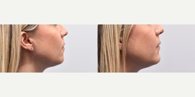 Chin Filler before and after photo