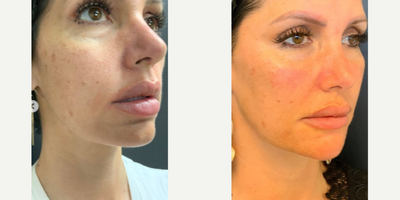 Dermal Fillers before and after photo