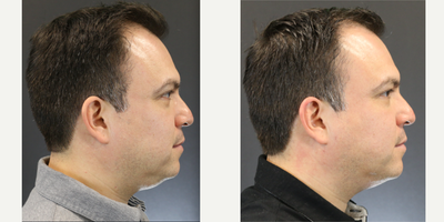FaceTite before and after photo