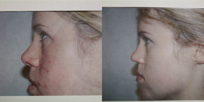 Laser Genesis before and after photo
