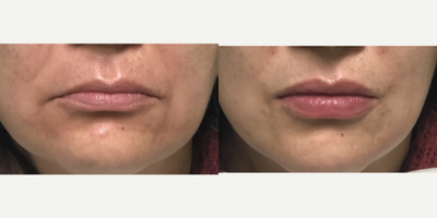 Lip Fillers before and after photo