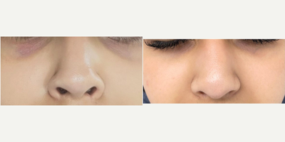 Microneedling before and after photo