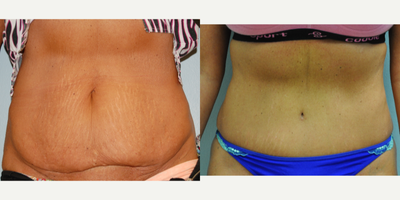 Tummy Tuck before and after photo