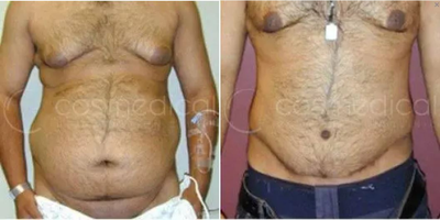 Tummy Tuck before and after photo