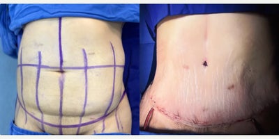 Tummy Tuck before and after photo