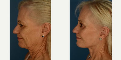 Brow Lift before and after photo