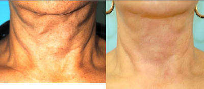 Exilis before and after photo