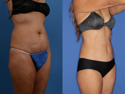 Liposuction before and after photo