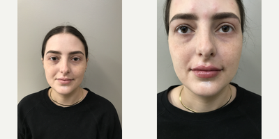 Restylane before and after photo