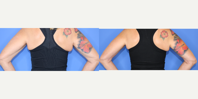 Arm Lift before and after photo