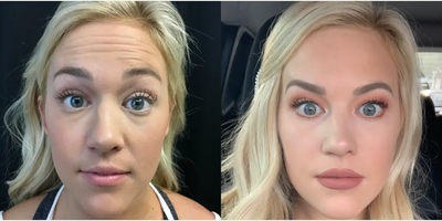Botox before and after photo