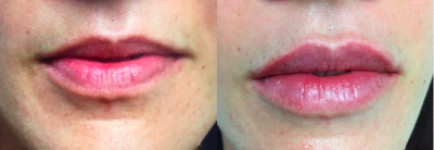 Dermal Fillers before and after photo