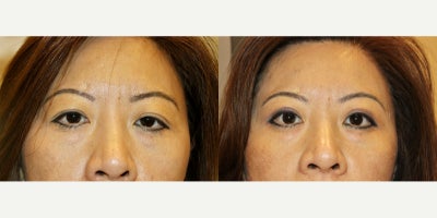 Double Eyelid Surgery before and after photo