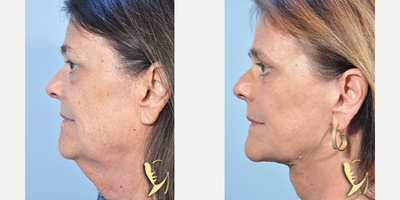 Facelift before and after photo